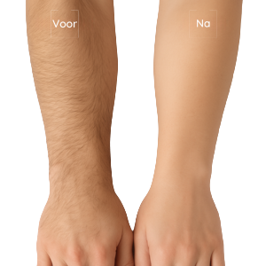Laserontharing mannen venlo